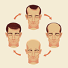 Baldness Alopecia